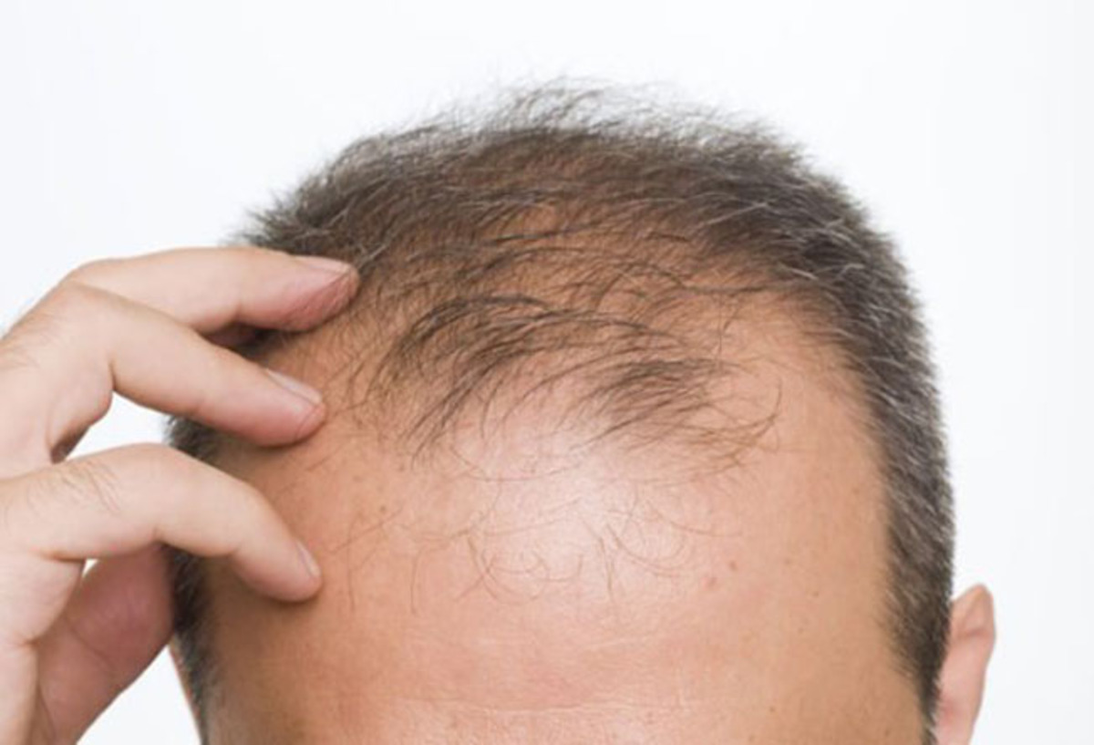 Truques para não ficar careca